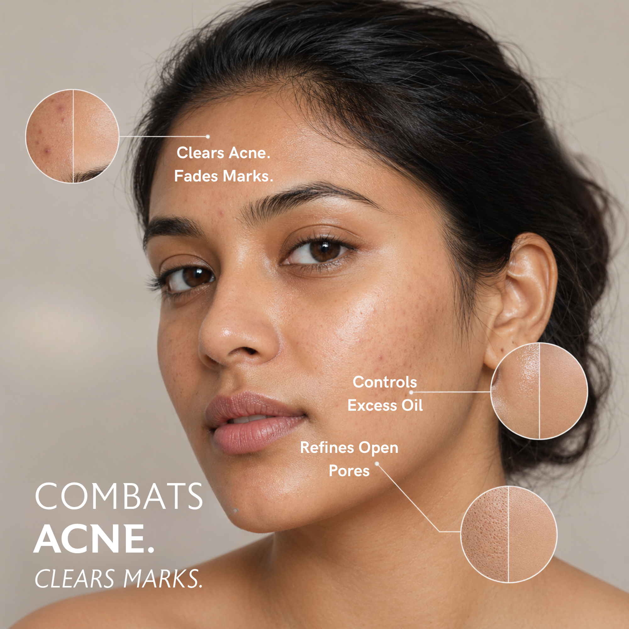 Acne & Breakouts